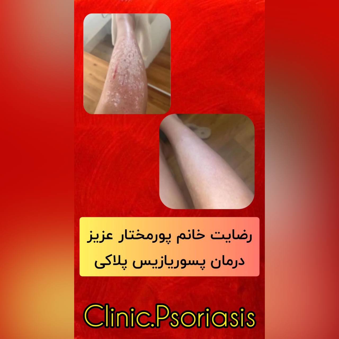 درمان پیسی و پسوریازیس