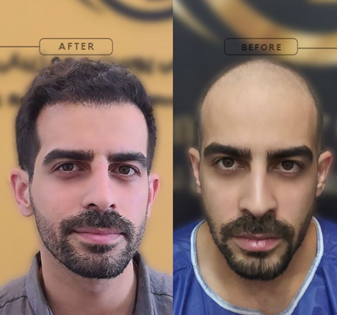 جشنواره کاشت مو ،ابرو ، ریش