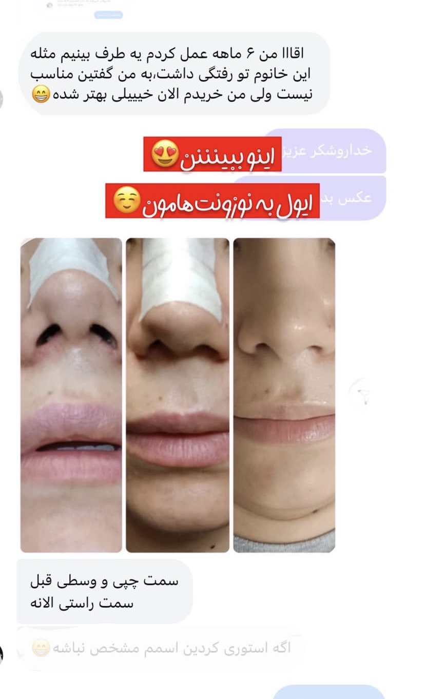 نوستریل متقارن کننده سوراخ های بینی