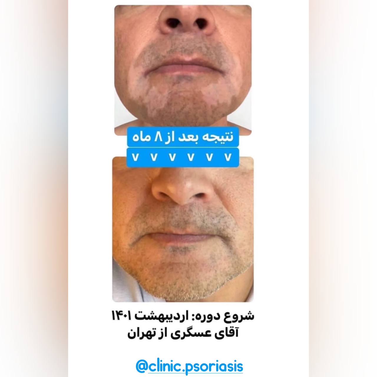 درمان پیسی و پسوریازیس