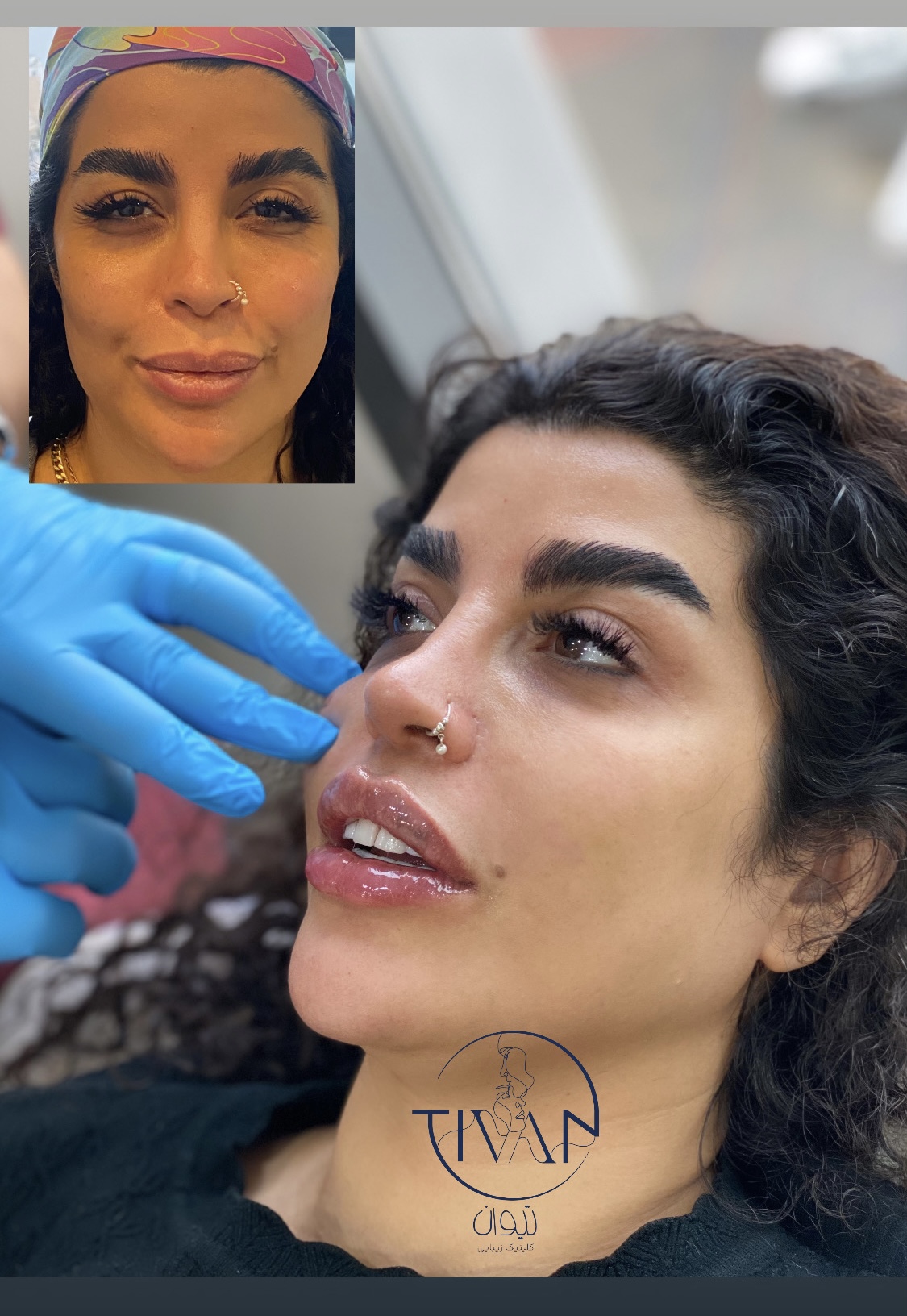 تزریقات زیبایی