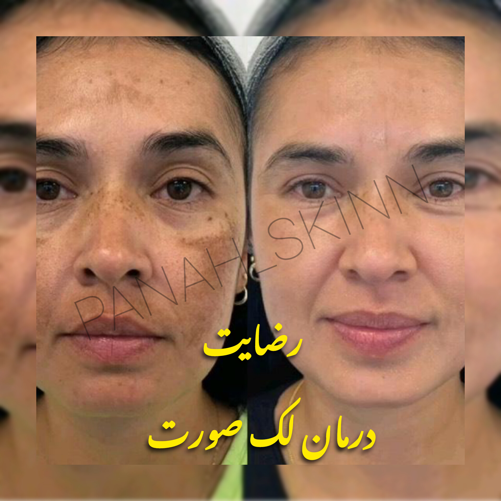 سرم ضدلک لاکچرکوین فرانسه 