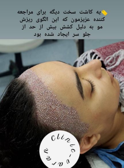 آموزش کاشت مو و ابرو تضمینی