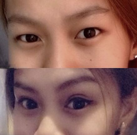 جراحی زیبایی پلک