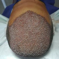 کاشت مو و ابرو 