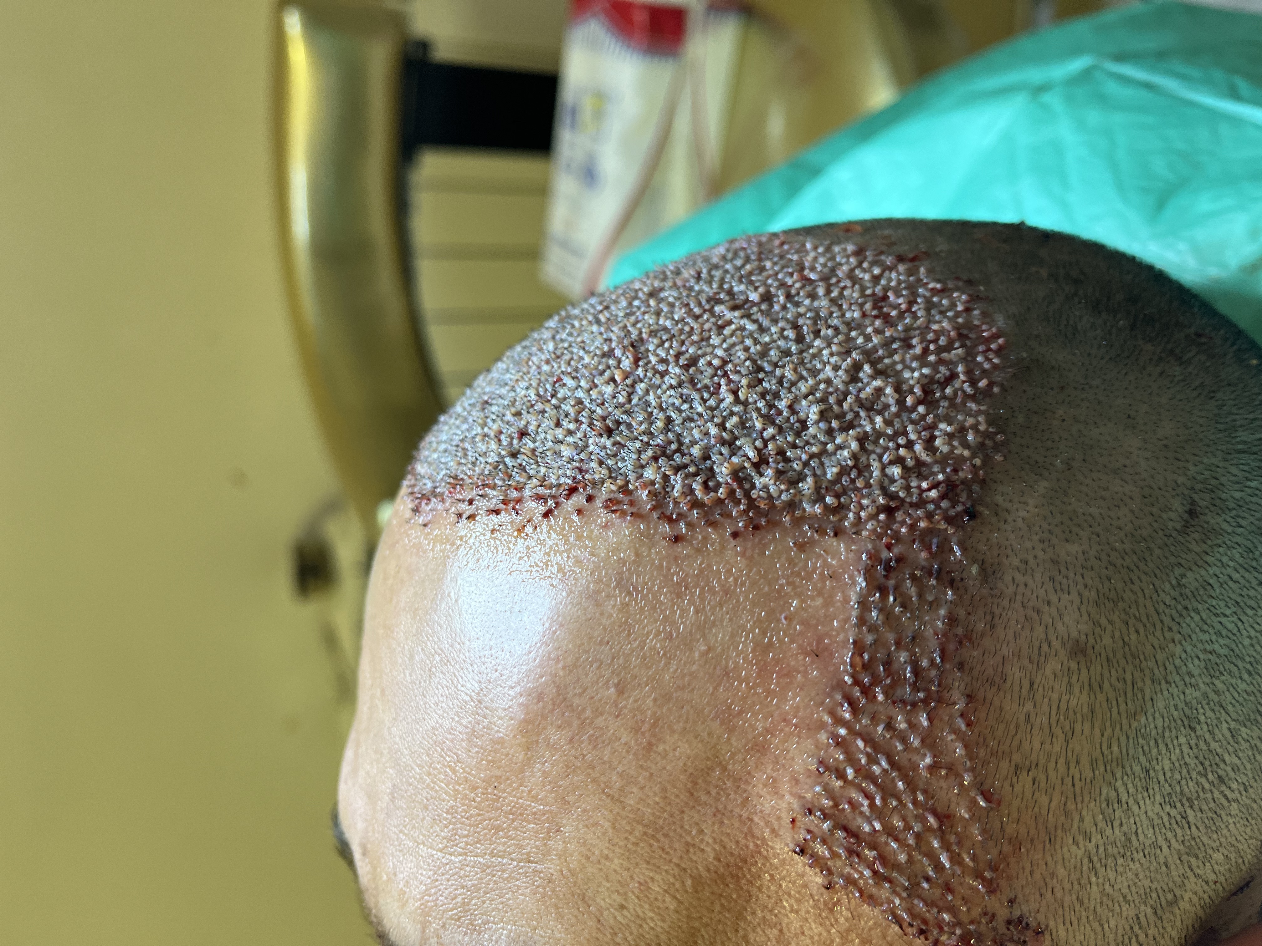 کاشت مو و ابرو توسط کادر درمان