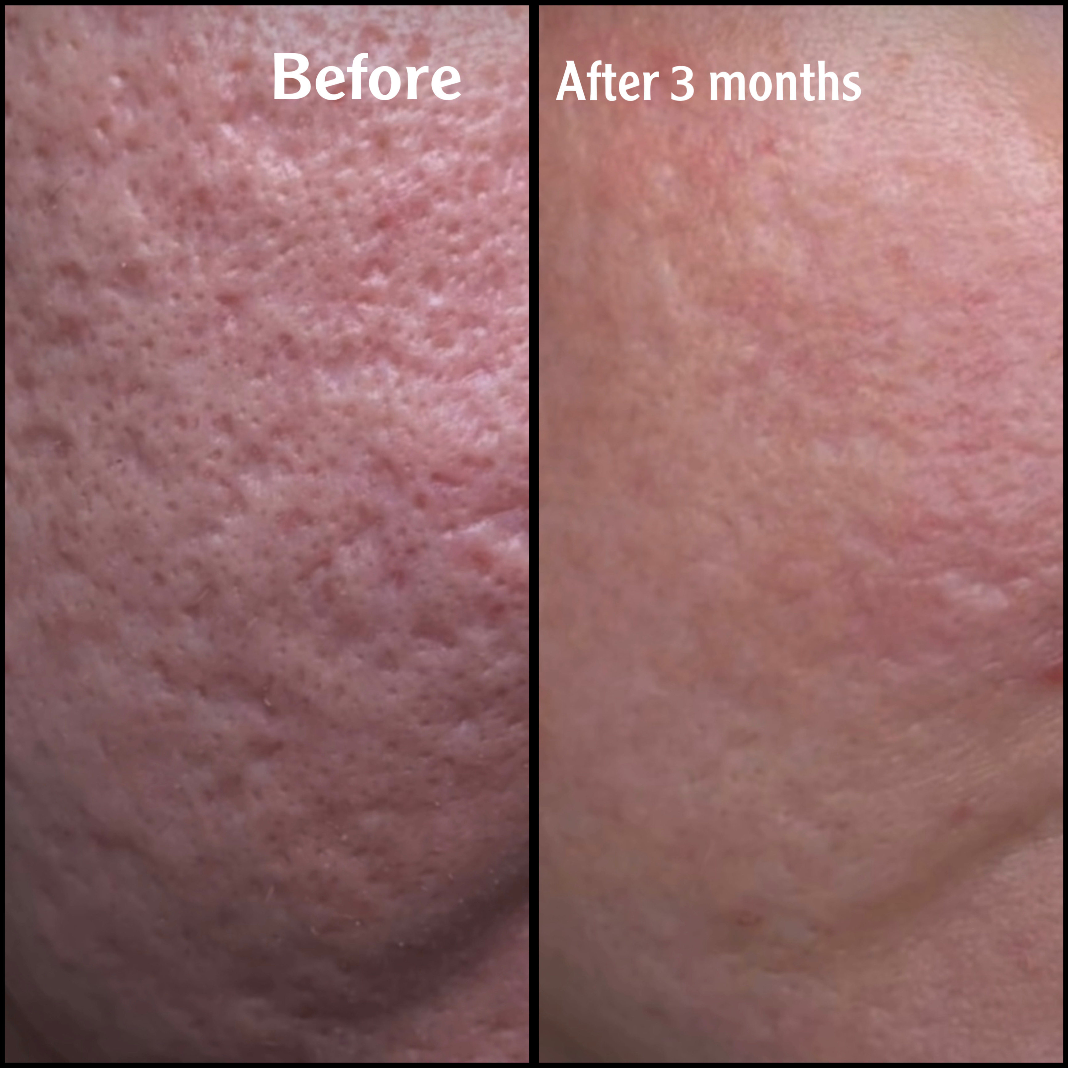 درمان قطعی انواع لک و تیرگی 