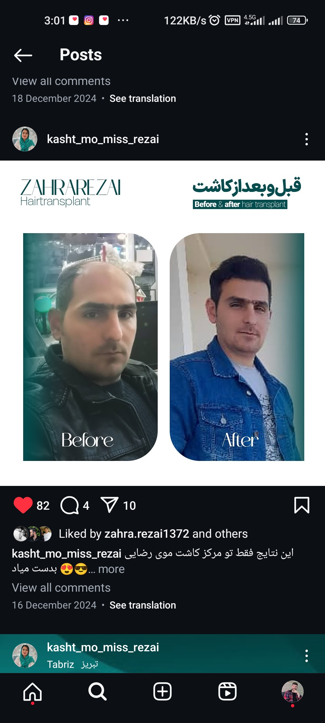 کاشت مو و کاشت ابرو