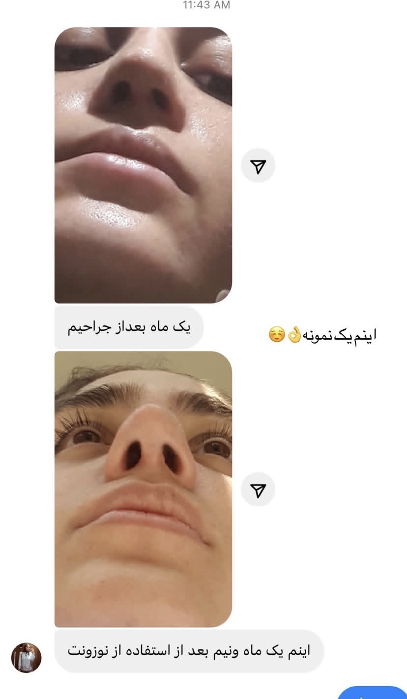 نوستریل متقارن کننده سوراخ های بینی