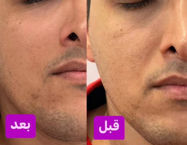 کرم سفت کننده صورت وایپر  لدورا