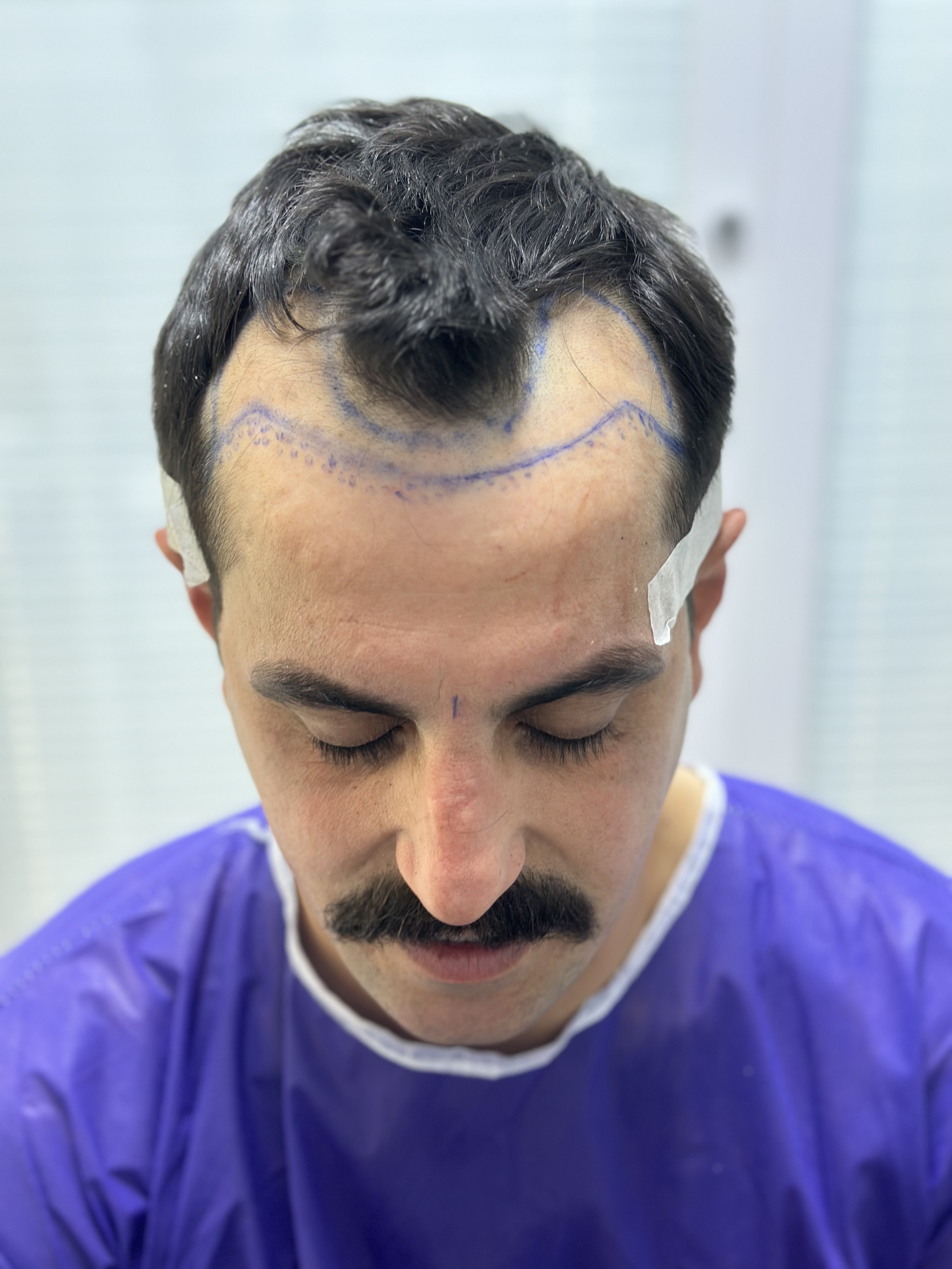 کاشت مو طبیعی 