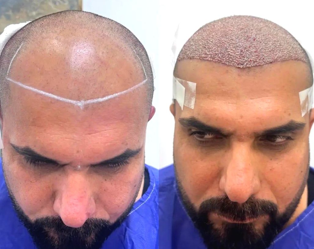 جشنواره کاشت مو ،ابرو ، ریش