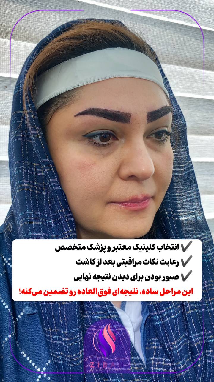 کاشت مو و کاشت ابرو 
