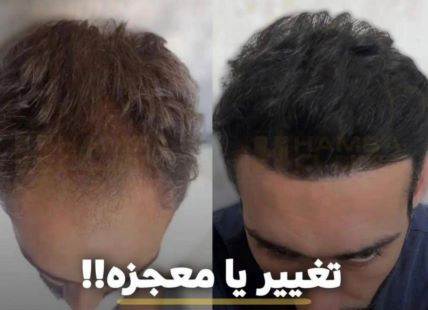 کاشت مو تضمیمی 