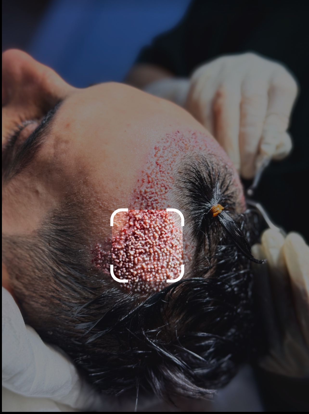 کاشت مو طبیعی 