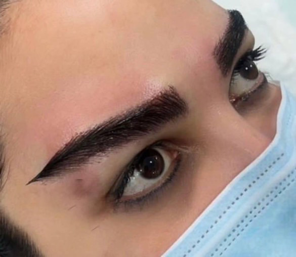 کاشت ابرو طبیعی پرتراکم