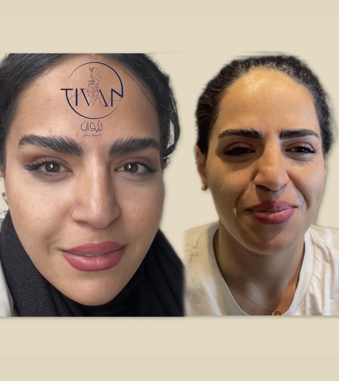 تزریقات زیبایی