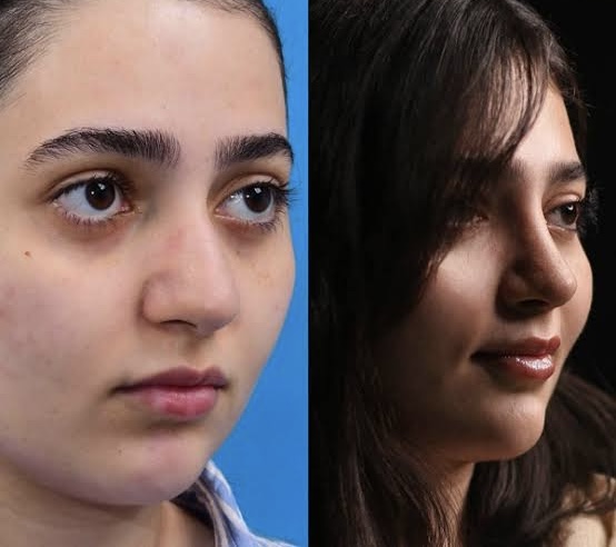 جراحی بینی و پلک