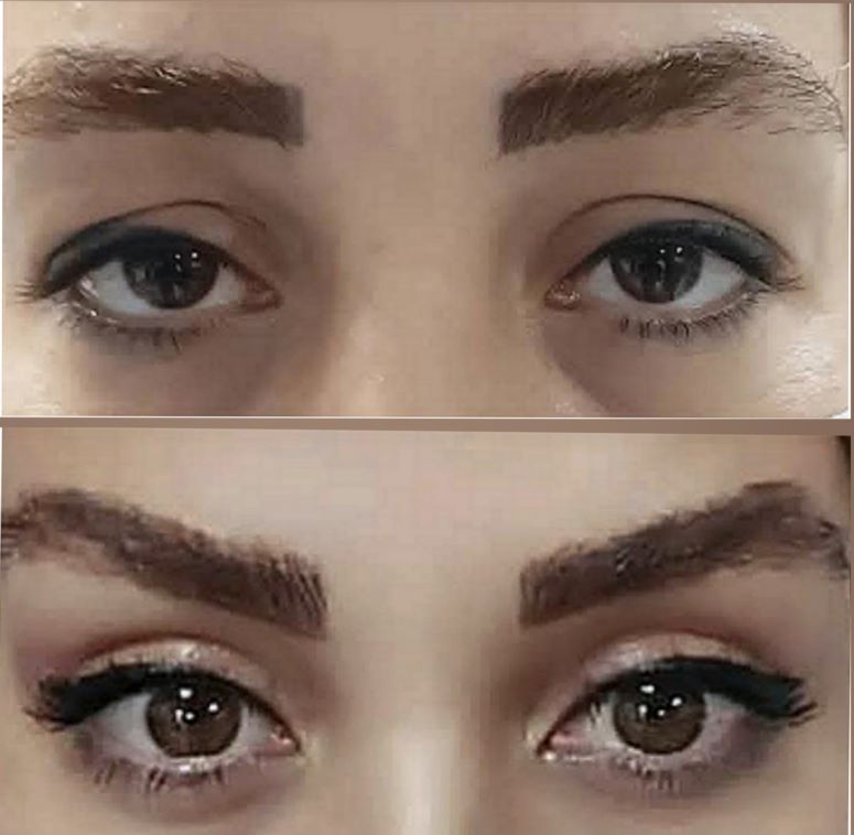 جراحی زیبایی پلک