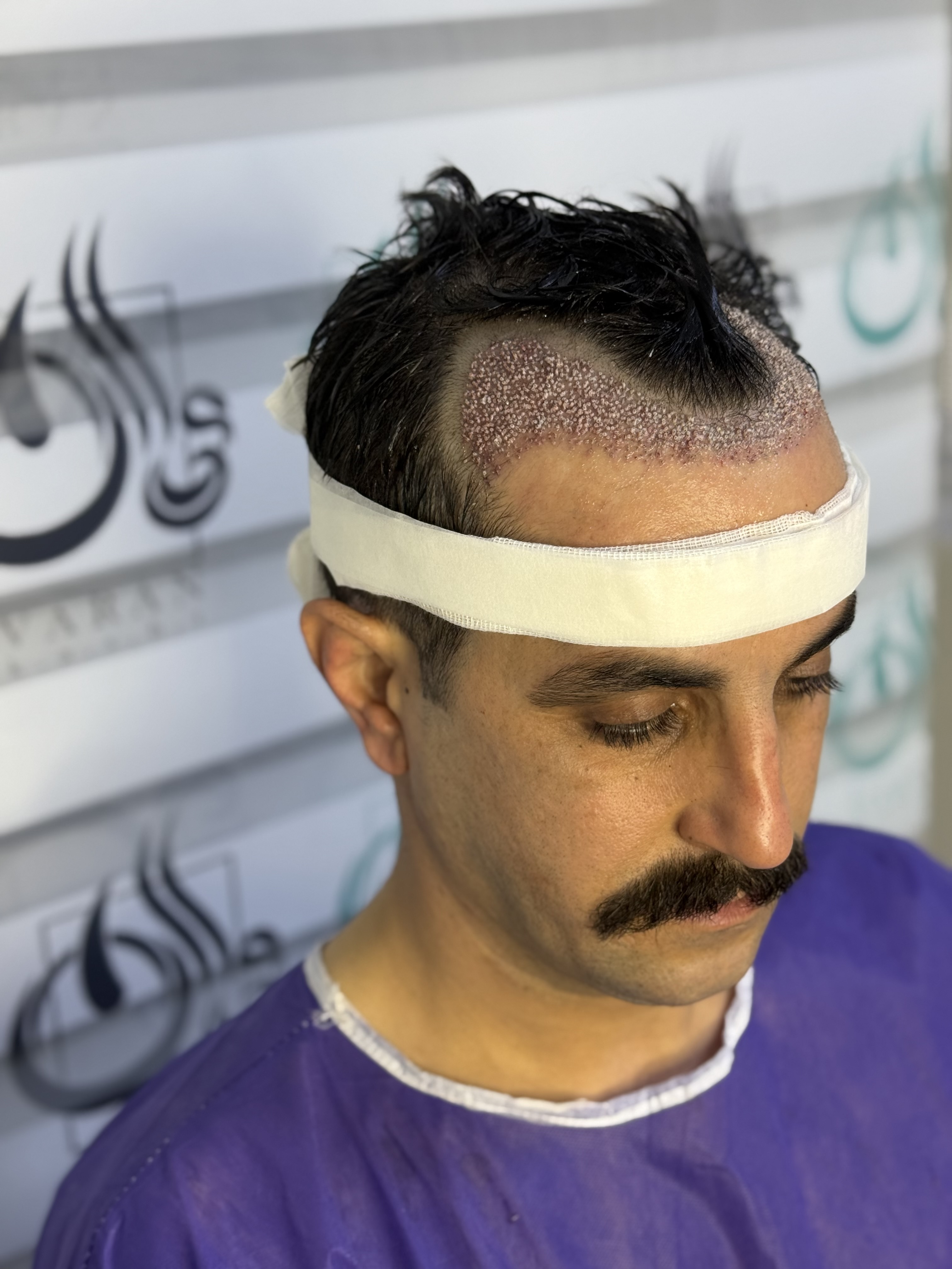 کاشت مو طبیعی 