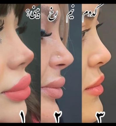 عمل زیبایی بینی
