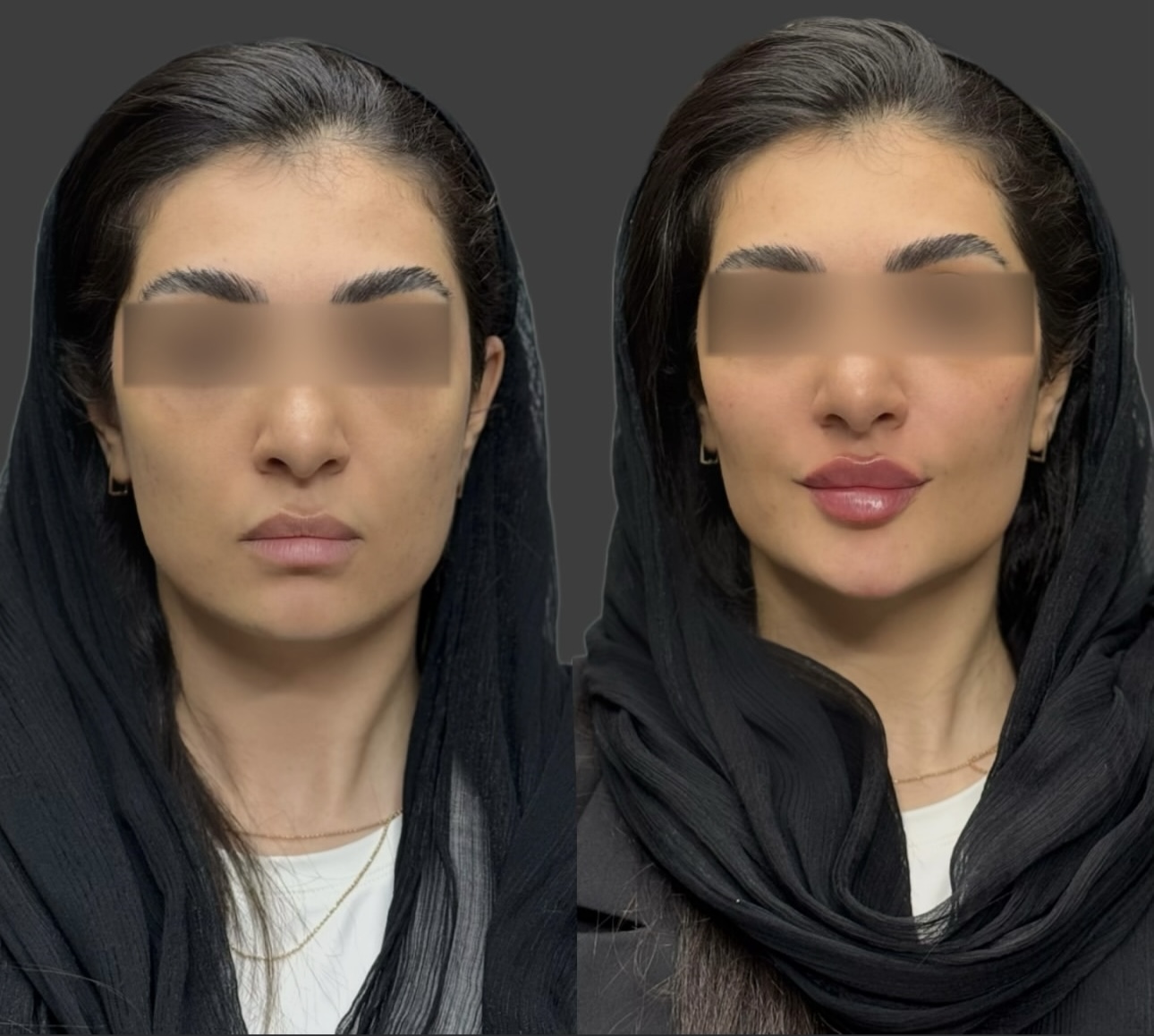 خدمات ژل و بوتاکس