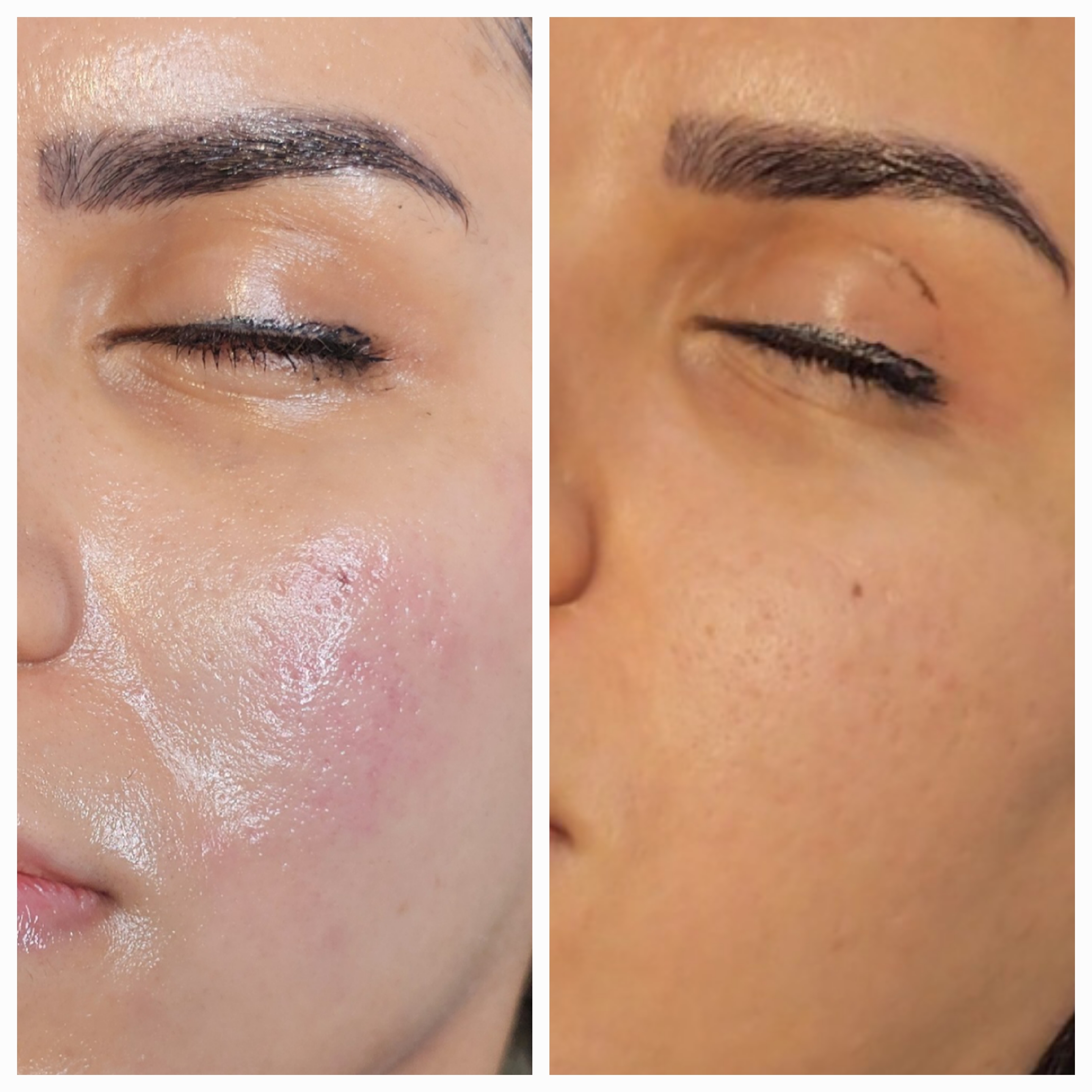 بوتاکس، تزریق ژل ،فیشال،خالبرداری