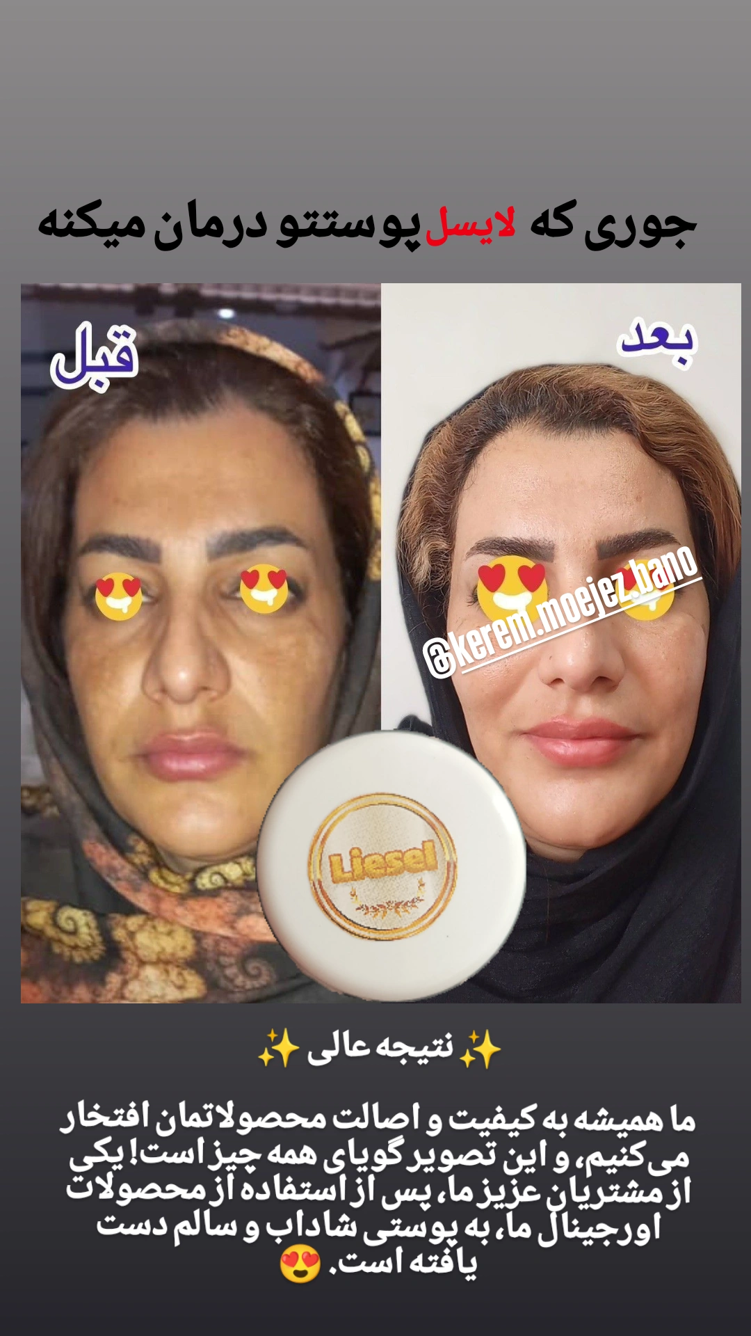 کرم ضدلک و سفید کننده 