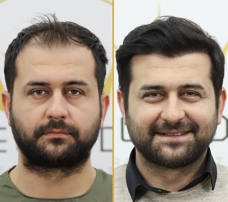 رویش مجدد مو 