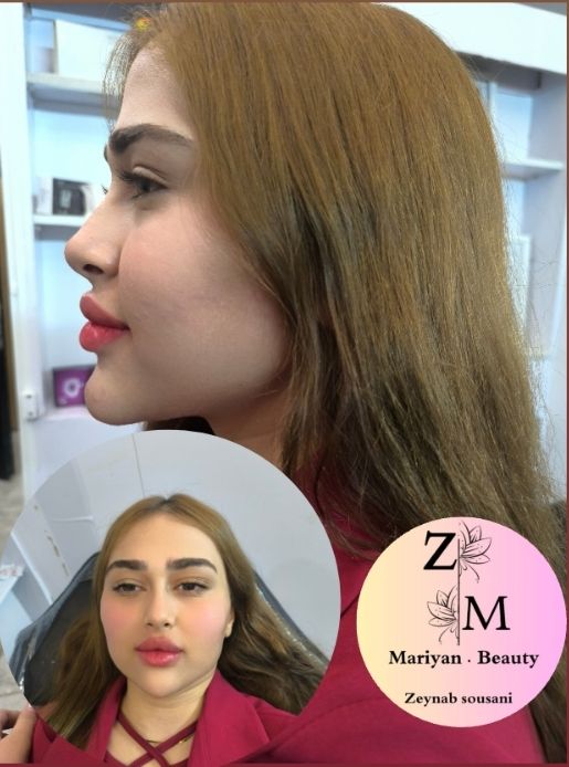 تزریق تخصصی ژلو بوتاکس