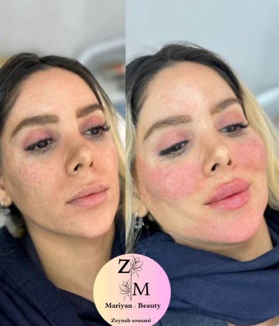 تزریق تخصصی ژلو بوتاکس
