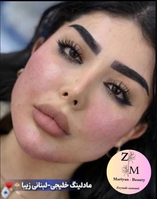 تزریق تخصصی ژلو بوتاکس