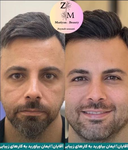 تزریق تخصصی ژلو بوتاکس