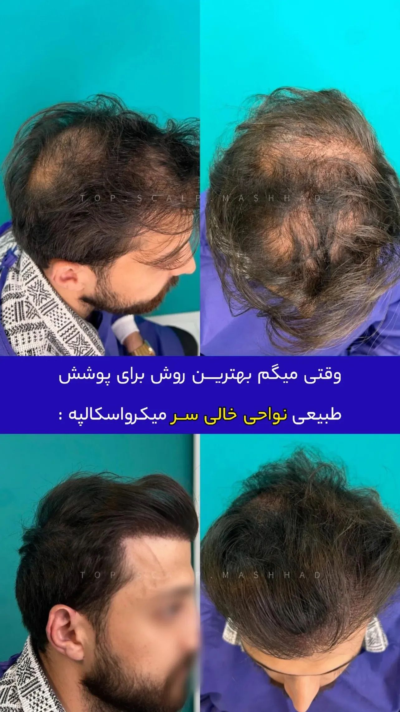 میکرو اسکالپ سر