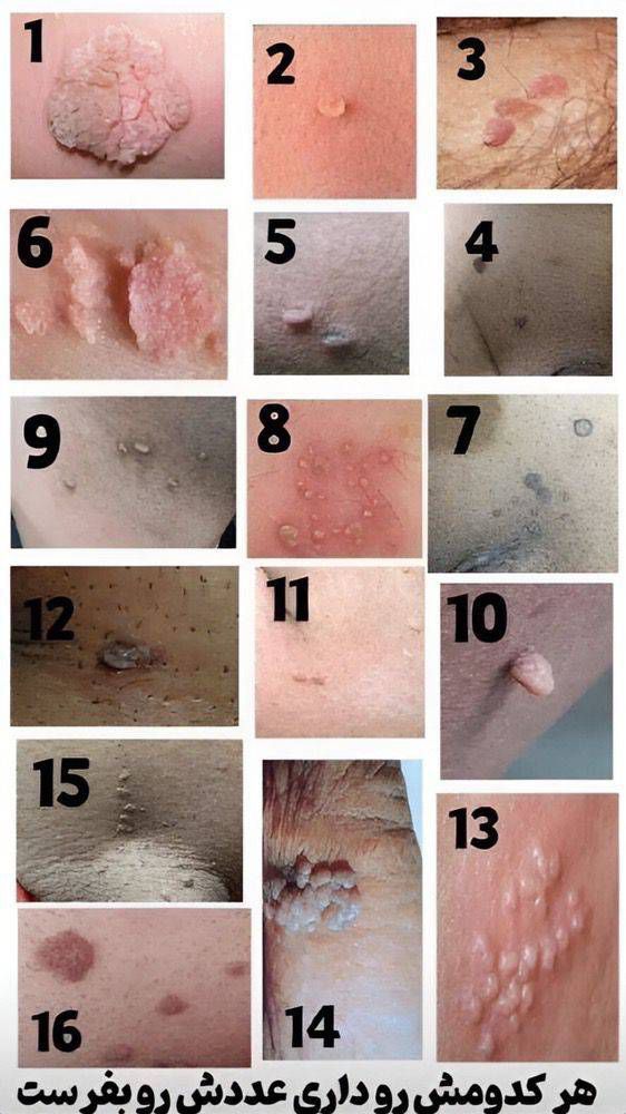 درمان تخصصی بیماریHPV.HSV زگیل و تبخال