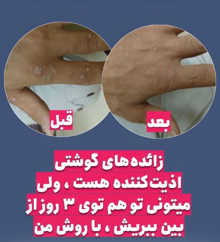 درمان تخصصی بیماریHPV.HSV زگیل و تبخال