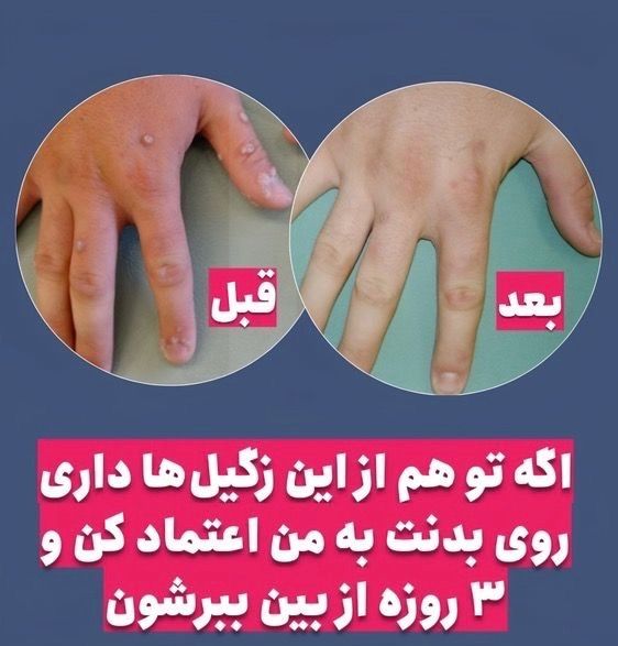 درمان تخصصی بیماریHPV.HSV زگیل و تبخال