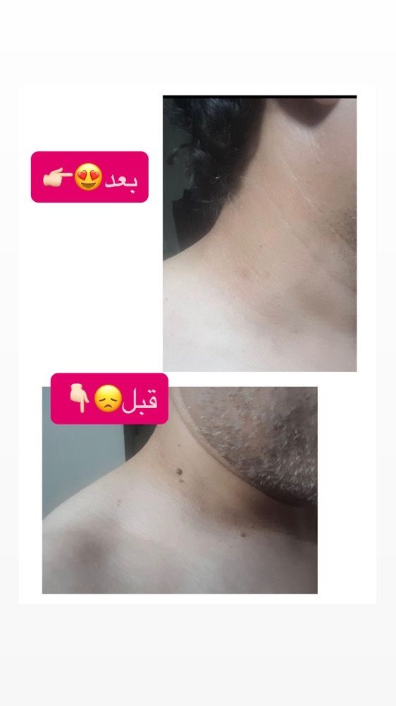 درمان تخصصی بیماریHPV.HSV زگیل و تبخال