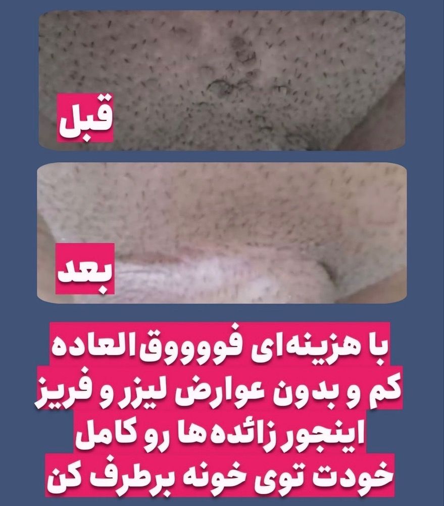 درمان تخصصی بیماریHPV.HSV زگیل و تبخال