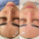 فیشیال_صورت 