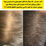 درمان قطعی انواع ریزش مو