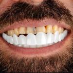 لمینت متحرک دندان