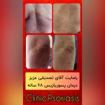 درمان پیسی و پسوریازیس