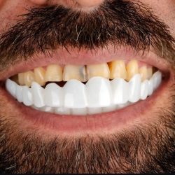 لمینت متحرک دندان