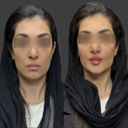خدمات ژل و بوتاکس