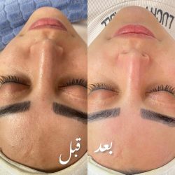 فیشیال_صورت 
