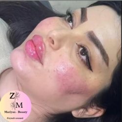 تزریق تخصصی ژلو بوتاکس تزریق تخصصی ژلو بوتاکس