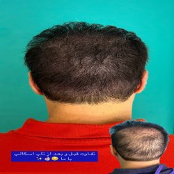 میکرو اسکالپ سر