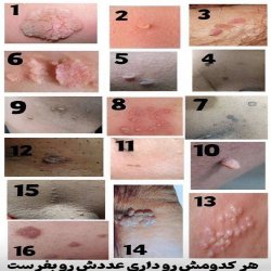 درمان تخصصی بیماریHPV.HSV زگیل و تبخال