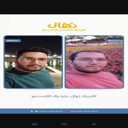 کاشت مو و زیبایی 